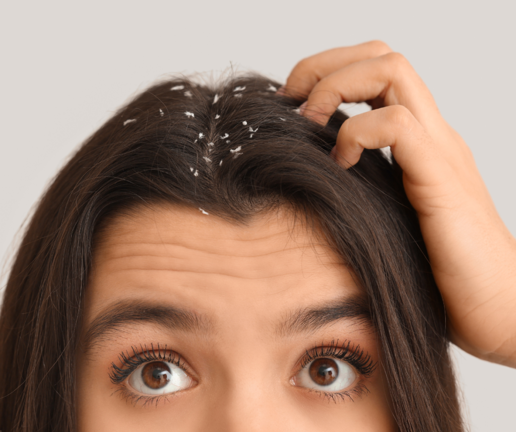 home remedies for dandruff 